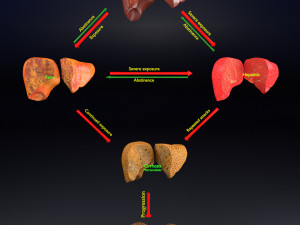 3D Alchoholic liver disease cirrhosis hepatitis fatty model Modelo 3D