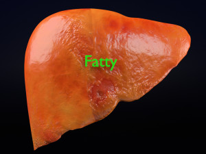 3D Alchoholic liver disease cirrhosis hepatitis fatty model Modelo 3D
