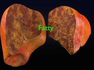 3D Alchoholic liver disease cirrhosis hepatitis fatty model Modelo 3D