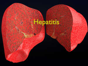 3D Alchoholic liver disease cirrhosis hepatitis fatty model Modelo 3D