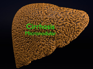 3D Alchoholic liver disease cirrhosis hepatitis fatty model Modelo 3D