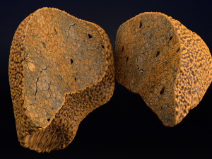 3D Alchoholic liver disease cirrhosis hepatitis fatty model Modelo 3D