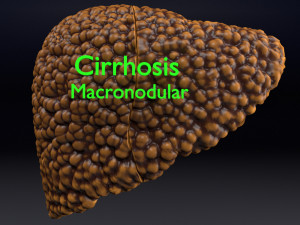 3D Alchoholic liver disease cirrhosis hepatitis fatty model Modelo 3D