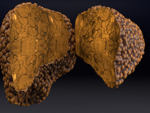 3D Alchoholic liver disease cirrhosis hepatitis fatty model Modelo 3D