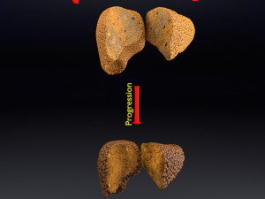3D Alchoholic liver disease cirrhosis hepatitis fatty model Modelo 3D