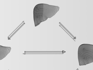 3D Alchoholic liver disease cirrhosis hepatitis fatty model Modelo 3D