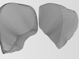 3D Alchoholic liver disease cirrhosis hepatitis fatty model Modelo 3D