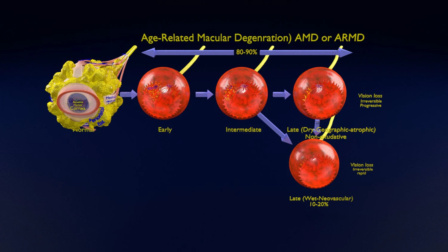 Age-related macular degeneration AMD ARMD detailed labelled animated model 3D 3D Model .c4d .max .obj .3ds .fbx .stl .blend 