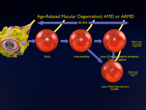 Age-related macular degeneration AMD ARMD detailed labelled animated model 3D 3D मॉडल