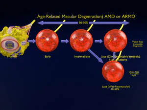 Degenerasi makula terkait usia AMD ARMD diberi label detail model animasi 3D Model 3D
