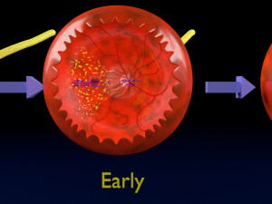 Age-related macular degeneration AMD ARMD detailed labelled animated model 3D Modello 3D