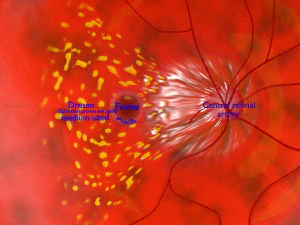 Age-related macular degeneration AMD ARMD detailed labelled animated model 3D 3D Model