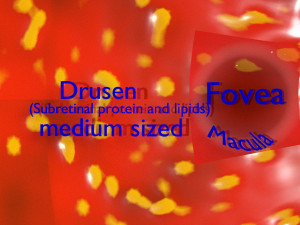 Age-related macular degeneration AMD ARMD detailed labelled animated model 3D Modello 3D