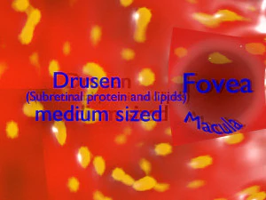 Age-related macular degeneration AMD ARMD detailed labelled animated model 3D 3D Model