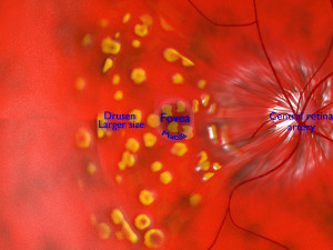 Age-related macular degeneration AMD ARMD detailed labelled animated model 3D Modello 3D