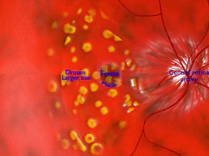 Age-related macular degeneration AMD ARMD detailed labelled animated model 3D 3D Model