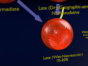 Age-related macular degeneration AMD ARMD detailed labelled animated model 3D Modello 3D