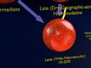 Age-related macular degeneration AMD ARMD detailed labelled animated model 3D 3D Model