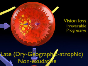 Age-related macular degeneration AMD ARMD detailed labelled animated model 3D Modello 3D