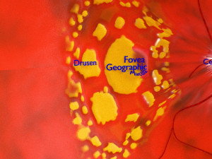Age-related macular degeneration AMD ARMD detailed labelled animated model 3D Modello 3D