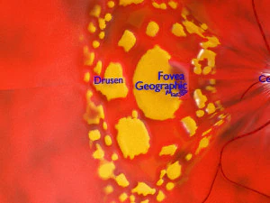 Age-related macular degeneration AMD ARMD detailed labelled animated model 3D 3D Model
