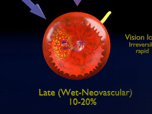 Age-related macular degeneration AMD ARMD detailed labelled animated model 3D 3D Model