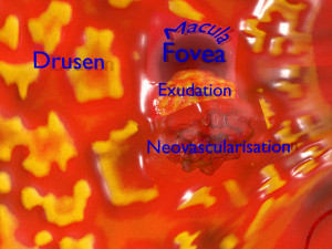 Age-related macular degeneration AMD ARMD detailed labelled animated model 3D Modello 3D