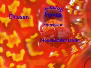 Age-related macular degeneration AMD ARMD detailed labelled animated model 3D 3D Model