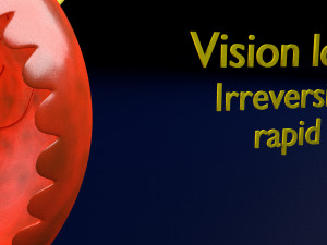 Age-related macular degeneration AMD ARMD detailed labelled animated model 3D Modello 3D