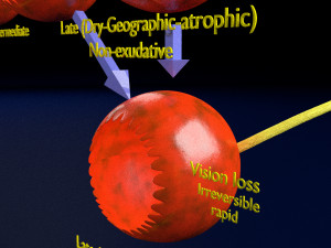 Age-related macular degeneration AMD ARMD detailed labelled animated model 3D Modello 3D