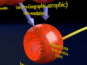 Age-related macular degeneration AMD ARMD detailed labelled animated model 3D 3D Model