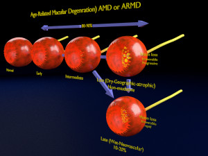 Age-related macular degeneration AMD ARMD detailed labelled animated model 3D Modello 3D