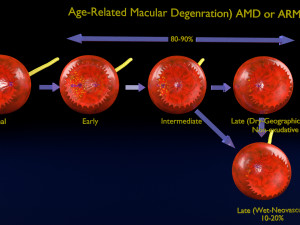 Age-related macular degeneration AMD ARMD detailed labelled animated model 3D Modello 3D