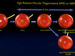 Age-related macular degeneration AMD ARMD detailed labelled animated model 3D 3D Model
