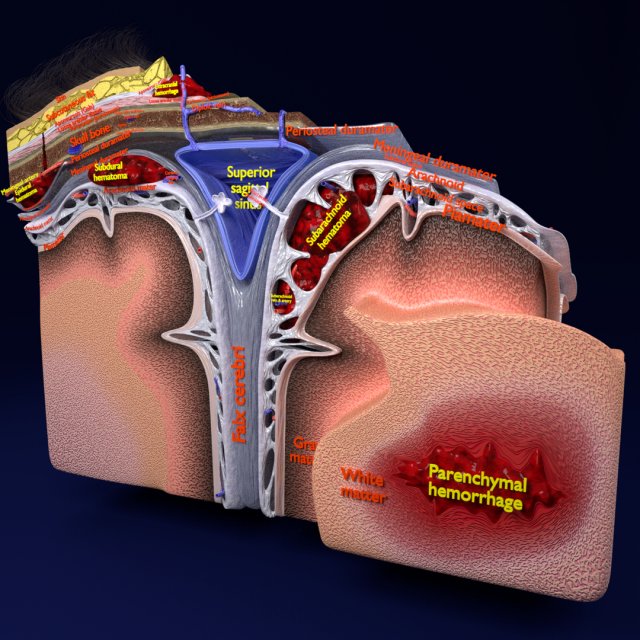 Brain hemorrhage types model Modelo 3D .c4d .max .obj .3ds .fbx .stl .blend 