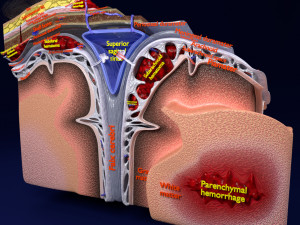Brain hemorrhage types model 3Dモデル