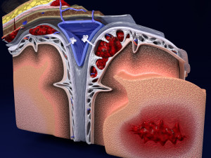 Brain hemorrhage types model Modelo 3D