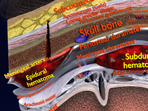 Brain hemorrhage types model Modelo 3D