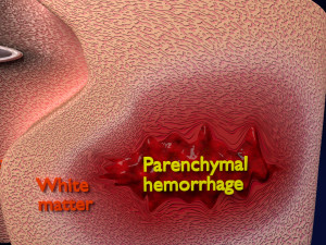 Brain hemorrhage types model Modelo 3D