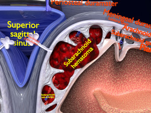 Brain hemorrhage types model Modelo 3D