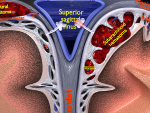Brain hemorrhage types model Modelo 3D