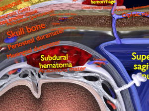 Brain hemorrhage types model Modelo 3D