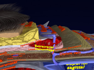 Brain hemorrhage types model Modelo 3D