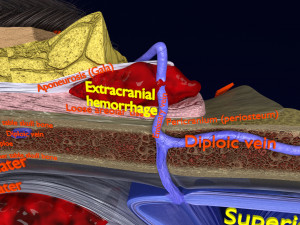 Brain hemorrhage types model Modelo 3D