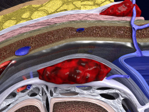 Brain hemorrhage types model Modelo 3D