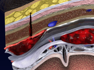 Brain hemorrhage types model Modelo 3D