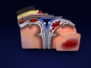 Brain hemorrhage types model Modelo 3D