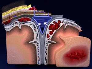 Brain hemorrhage types model Modelo 3D