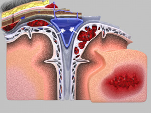 Brain hemorrhage types model Modelo 3D