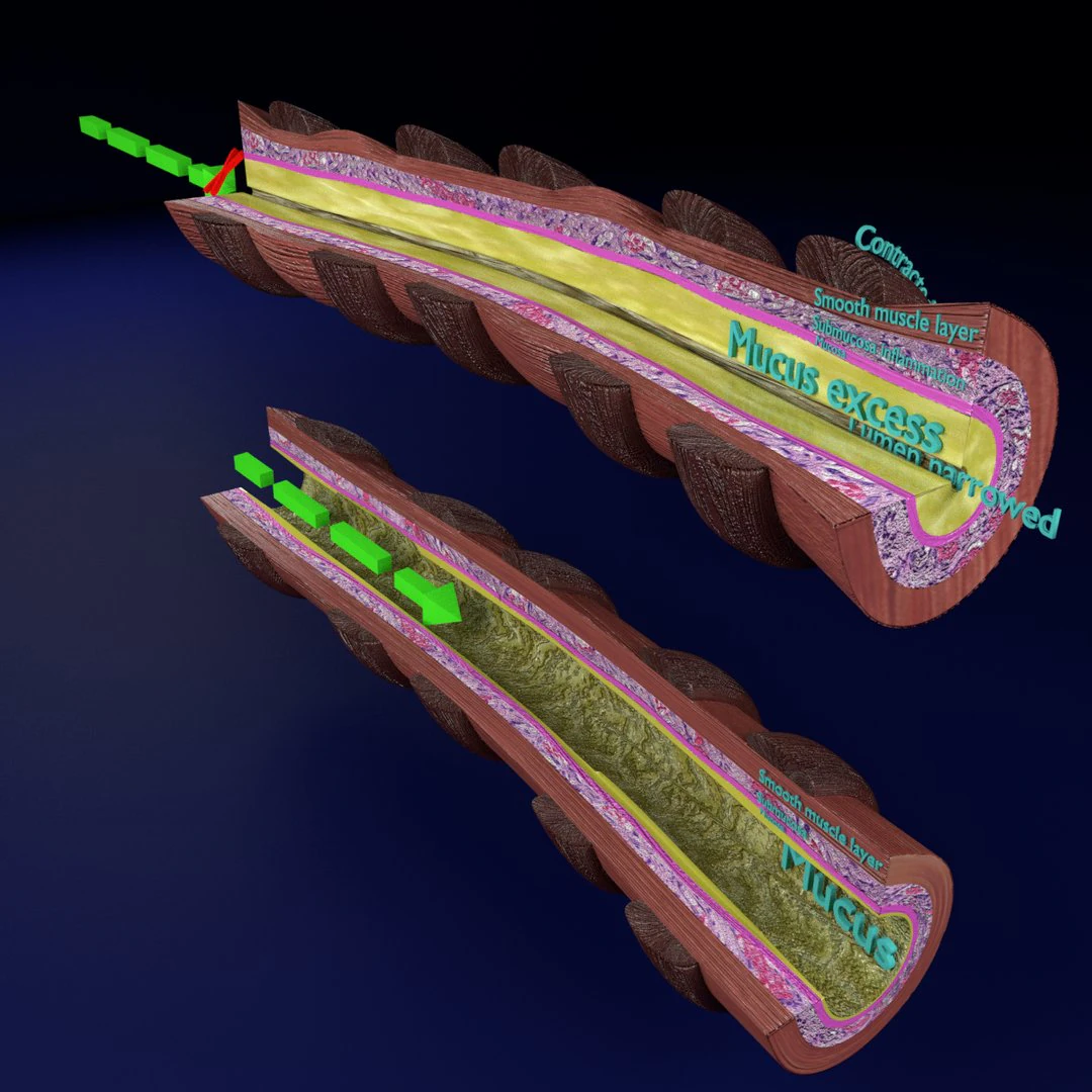 3D Asthma bronchiole obstruction model 3D Model .c4d .max .obj .3ds .fbx .stl .blend 